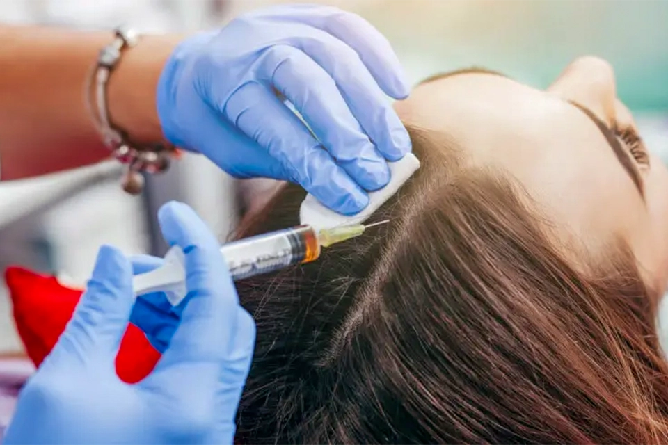 Injections de PRP pour la perte de cheveux