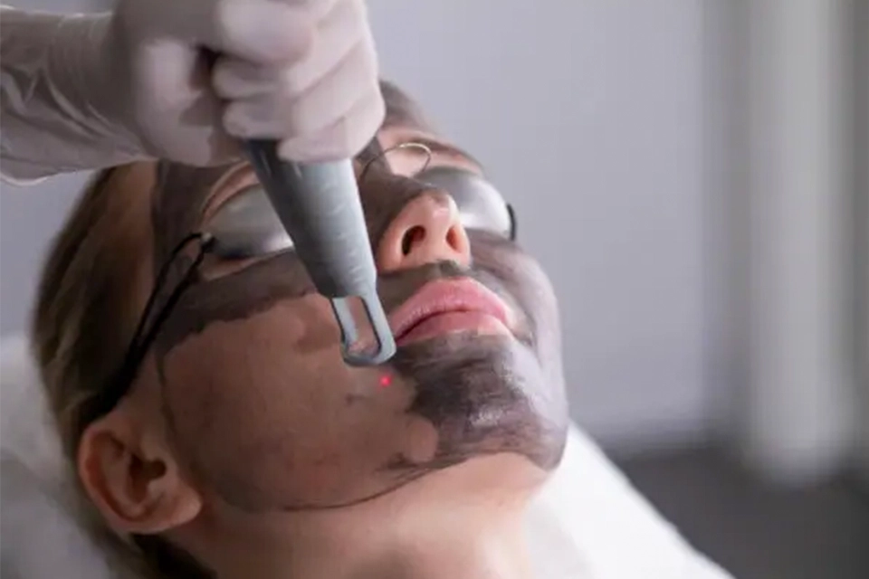 Le Peeling laser de carbone en Tunisie