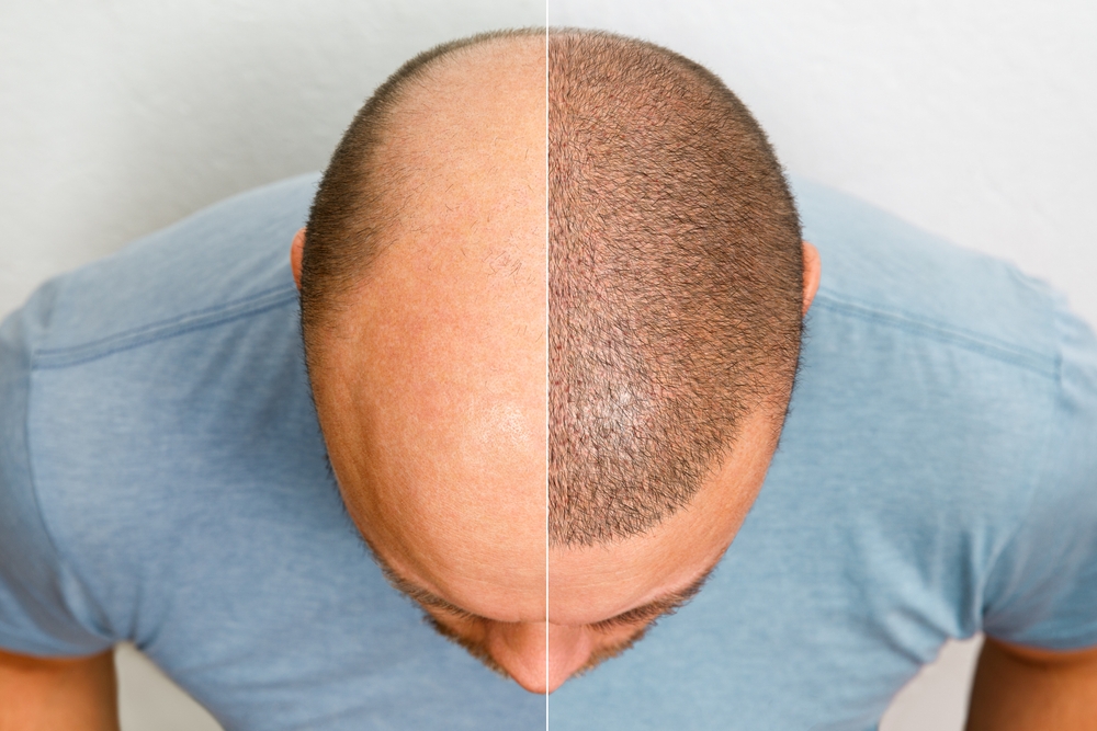 Greffe de Cheveux : Restaurez Votre Chevelure de Façon Naturelle