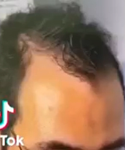 Greffe de cheveux pour hommes apres patient 10