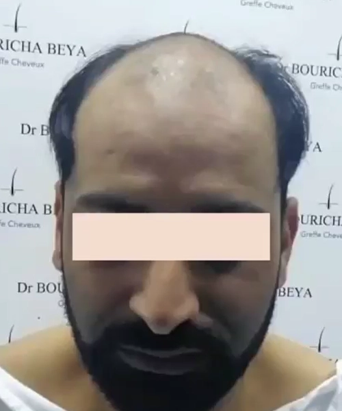 greffe cheveux tunisie patient 11