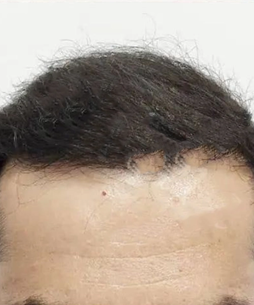 Greffe de cheveux pour hommes apres patient 13