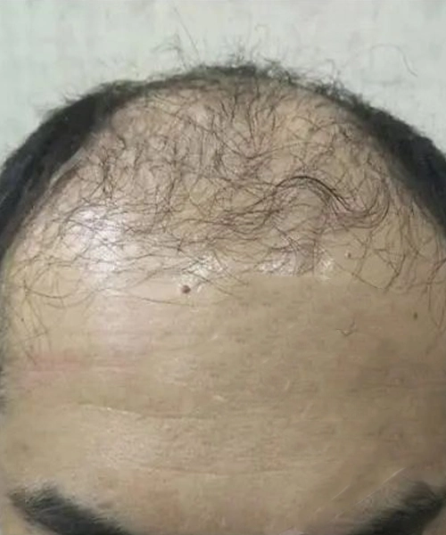 Greffe de cheveux pour hommes apres patient 13
