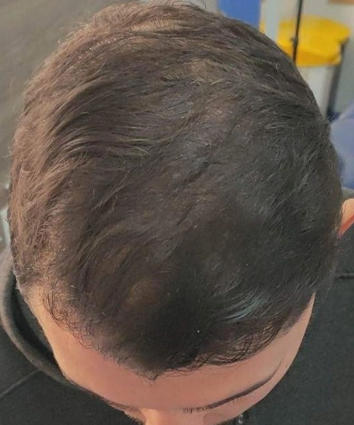 Greffe de cheveux pour hommes apres patient 6