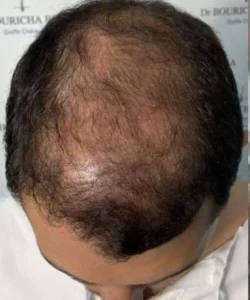 Greffe de cheveux pour hommes apres patient 6