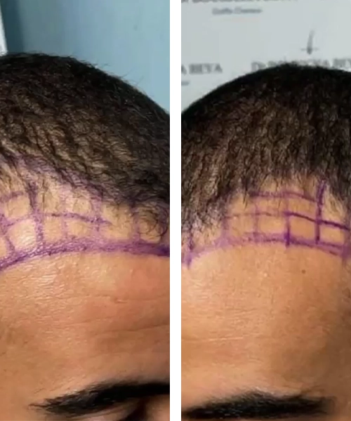 Greffe de cheveux pour hommes apres patient 8