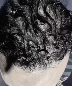 Greffe de cheveux pour hommes apres patient 9