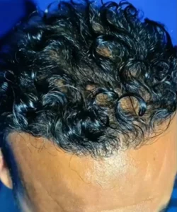 Greffe de cheveux pour hommes apres patient 9