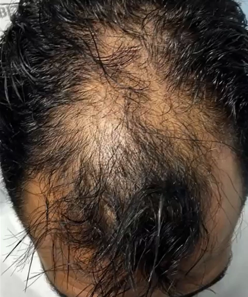 Greffe de cheveux pour hommes patient 5