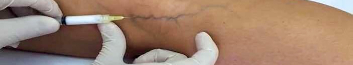 Varices varicosités vaisseaux dilatés