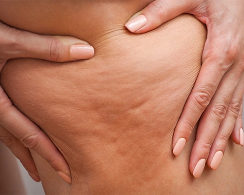 cellulite capitons graisse localisée