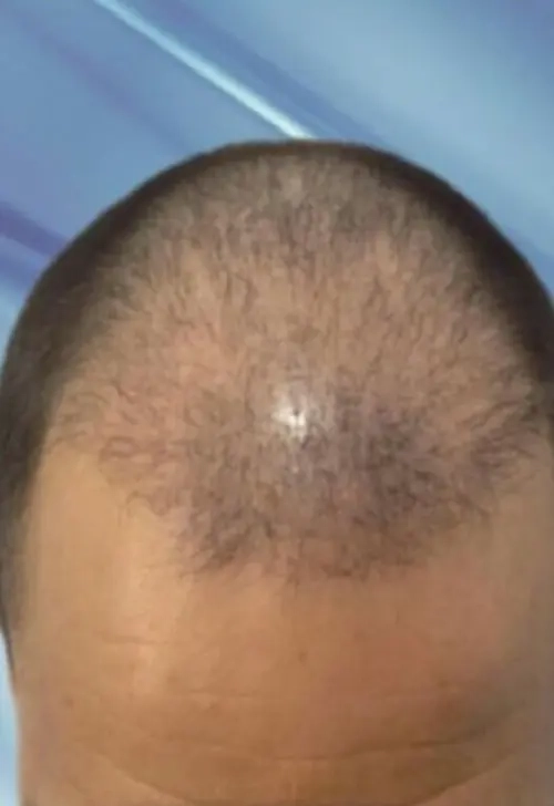 greffe cheveux tunisie patient 4