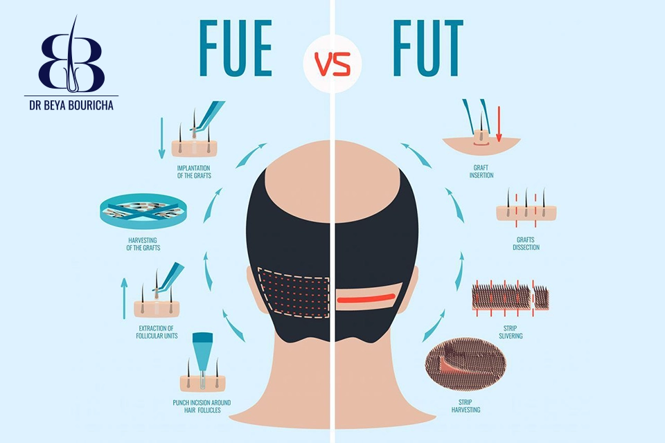 FUT vs FUE Comprendre les techniques de greffe capillaire en tunisie