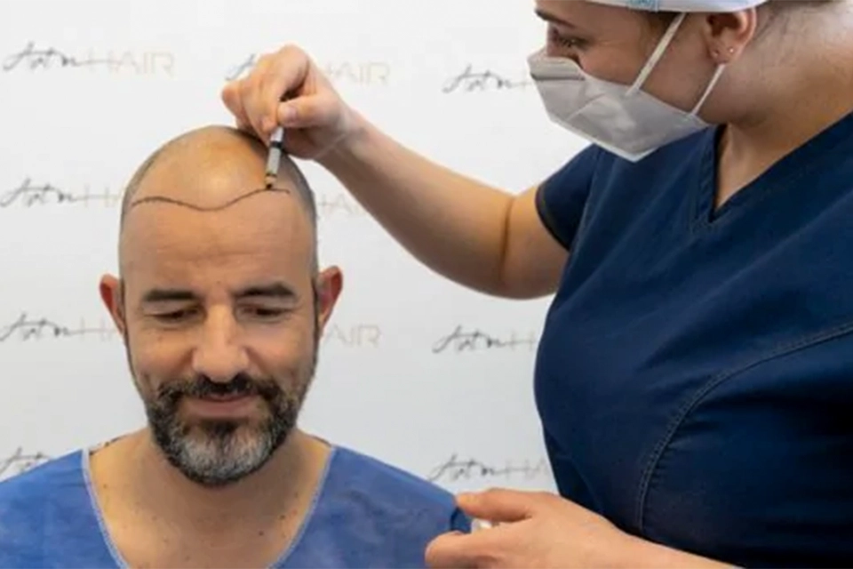 Greffe Cheveux Tunis : Guide Ultime pour retrouver une chevelure dense