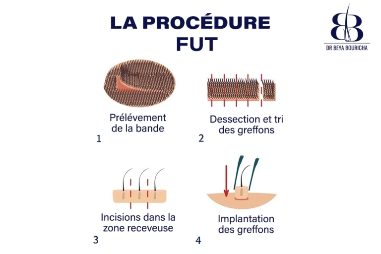 La technique FUT en Tunisie Une solution efficace pour la greffe de cheveux chez Beya Bouricha