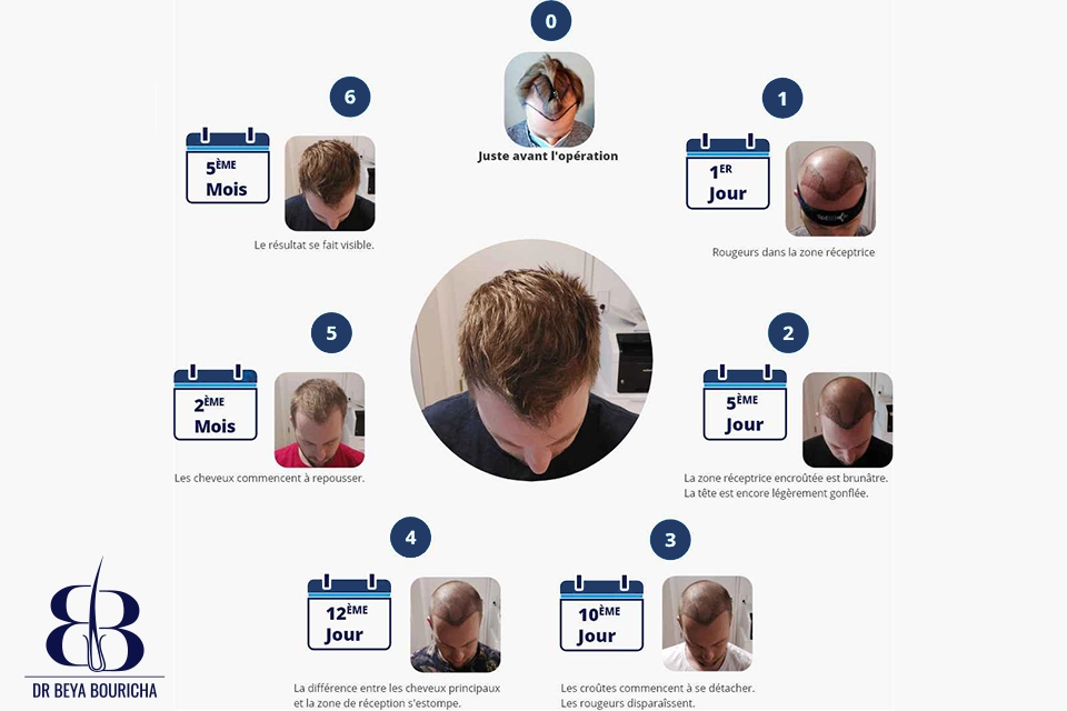 Le processus de la greffe de cheveux