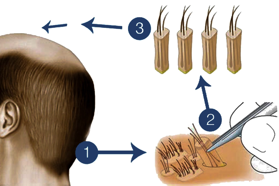 Les différentes techniques de greffe de cheveux utilisées