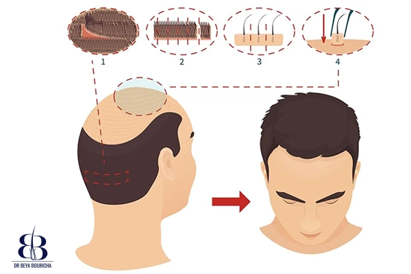 Les différentes techniques de greffe de cheveux utilisées par le Dr. Bouricha