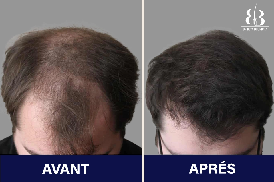 Témoignages de patients satisfaits de la greffe de cheveux Tunisie