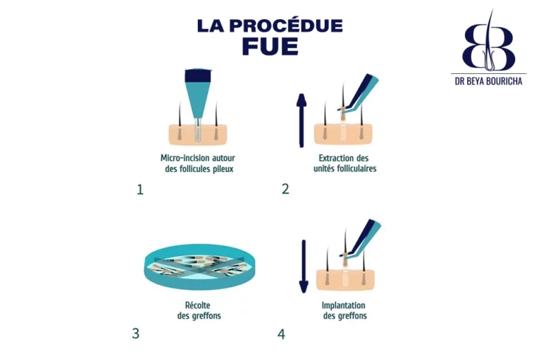 Tout ce que vous devez savoir sur la technique FUE (Follicular Unit Extraction) pour Beya Bouricha