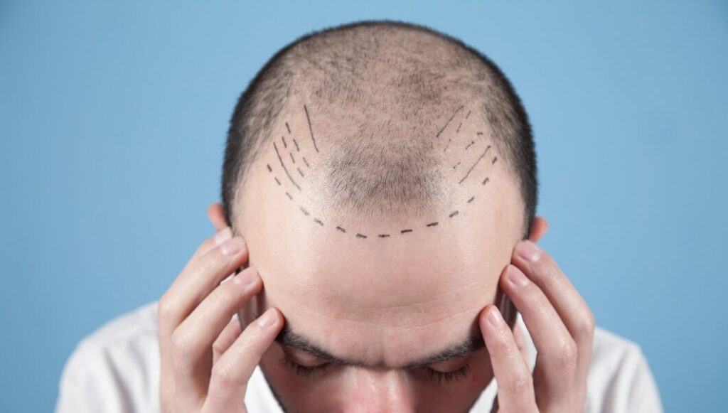 Une greffe de cheveux ratée : Que faire en cas de résultat insatisfaisant ?