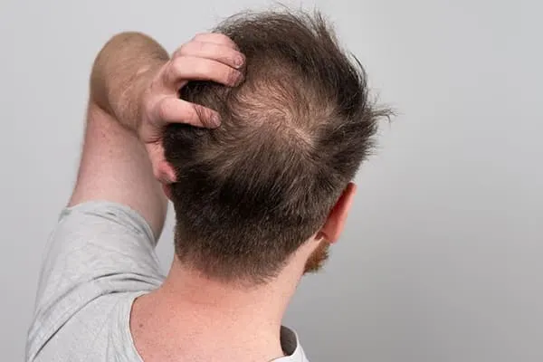 Calvitie précoce : pourquoi perd-on ses cheveux jeune ?