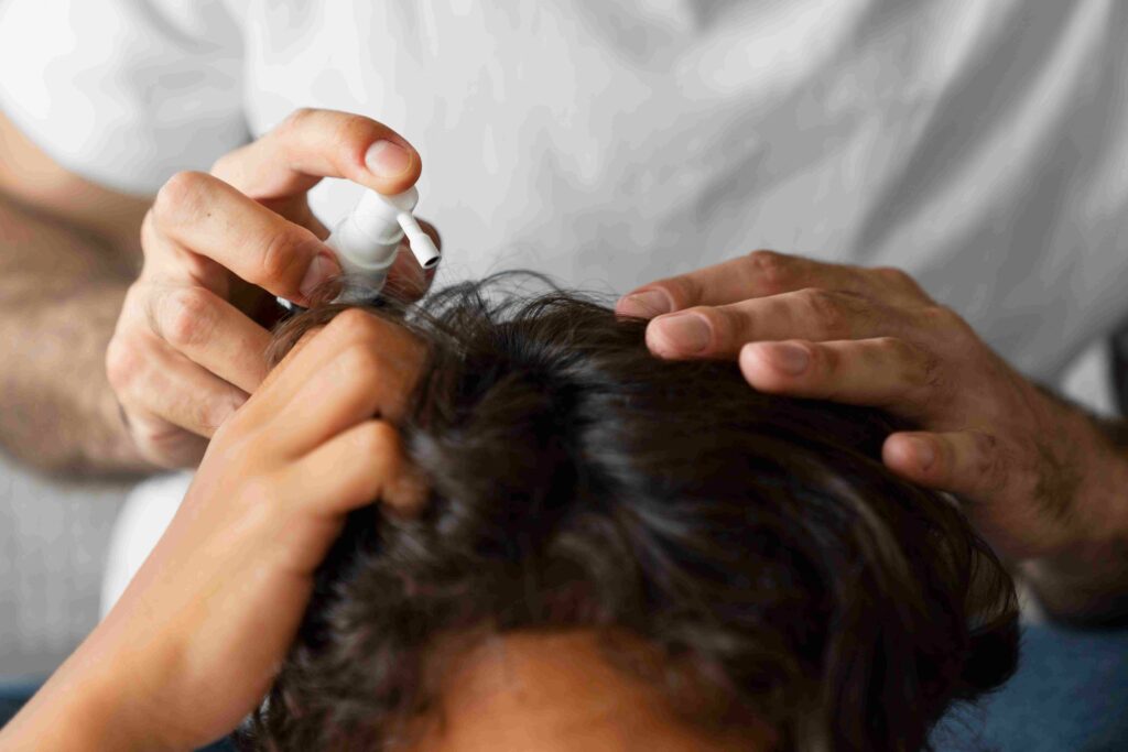 minoxidil finastéride greffe de cheveux